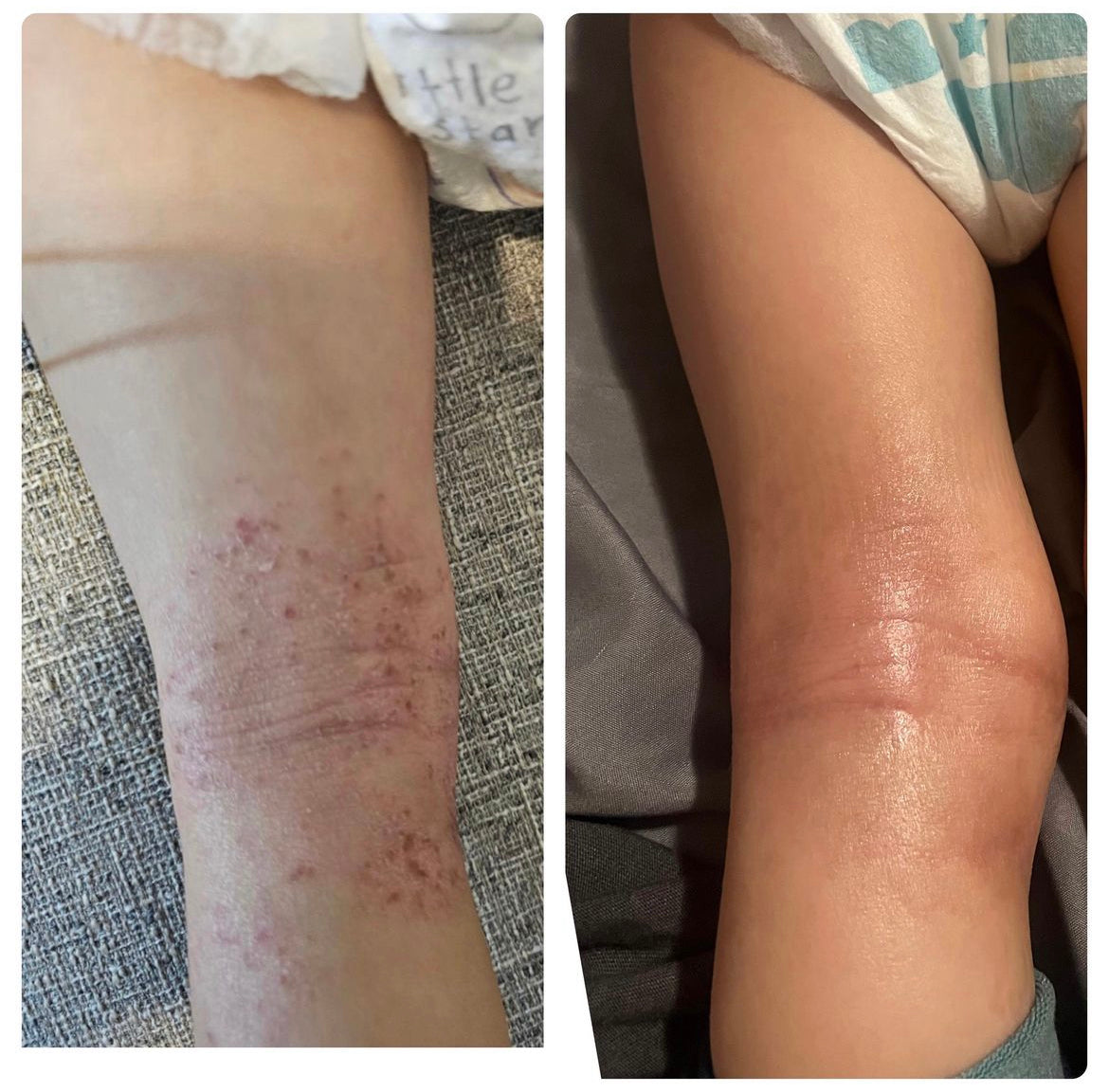 Soppi Eczema Oil